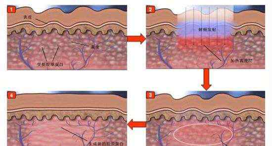 激光祛斑安全嗎 激光祛斑安全嗎，會(huì)不會(huì)對(duì)皮膚造成傷害