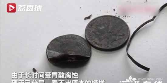 男孩吃餃子吞下2枚硬幣1年后取出 具體什么情況