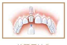 鑲牙和種植牙的區(qū)別 你關(guān)心的鑲牙和種植牙，究竟有什么區(qū)別！