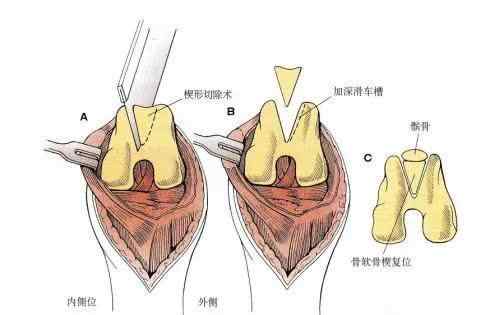 膝蓋內側疼痛是咋回事 左膝蓋內側一按壓就疼怎么回事？可能是這3種疾病導致