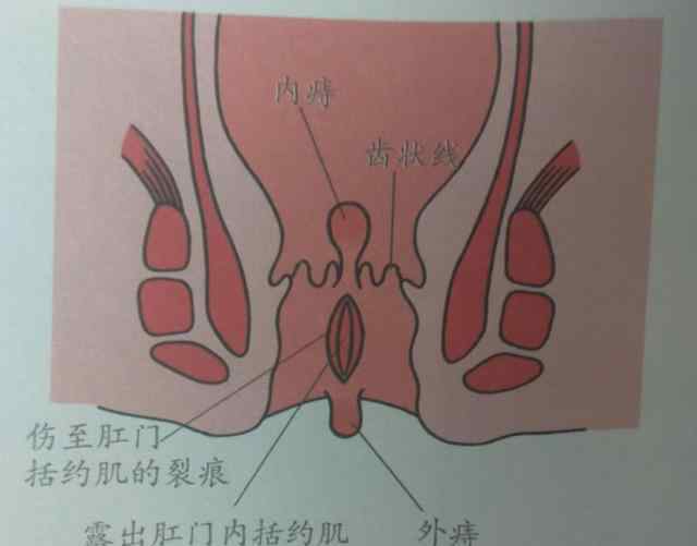 混合痔4期圖片 痔瘡有3型4期，你是哪一型，哪一期？