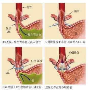 反流性食管炎嚴(yán)重嗎 反流性食管炎不嚴(yán)重？它這三個(gè)危害，你能忽視嗎？