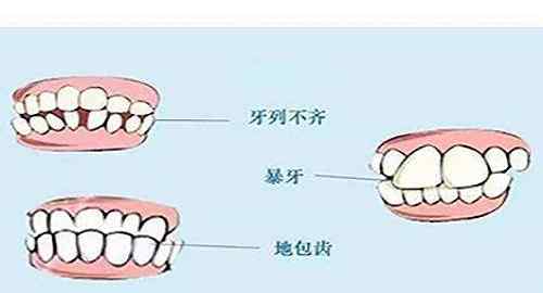 牙齒矯正需要多久 一般的牙齒矯正時間需要多長時間