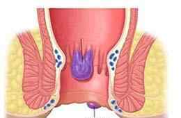 混合痔4期圖片 痔瘡有3型4期，你是哪一型，哪一期？