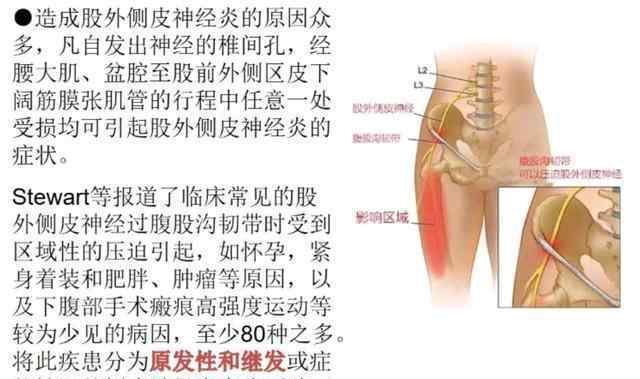 股外側(cè)皮神經(jīng)炎 股外側(cè)皮神經(jīng)炎概述