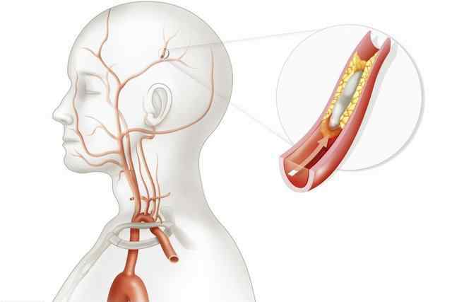 腦血管梗塞 腦血管堵塞前，身體會發(fā)出4個“求救”信號，學(xué)會2招遠離腦梗