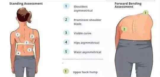 脊柱側(cè)彎自我檢測圖 孩子坐不端正、頭歪、駝背？小心脊柱側(cè)彎，醫(yī)生教你自我檢查