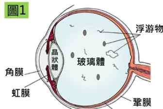 玻璃體混濁原因 引起玻璃體混濁的原因有哪些呢?