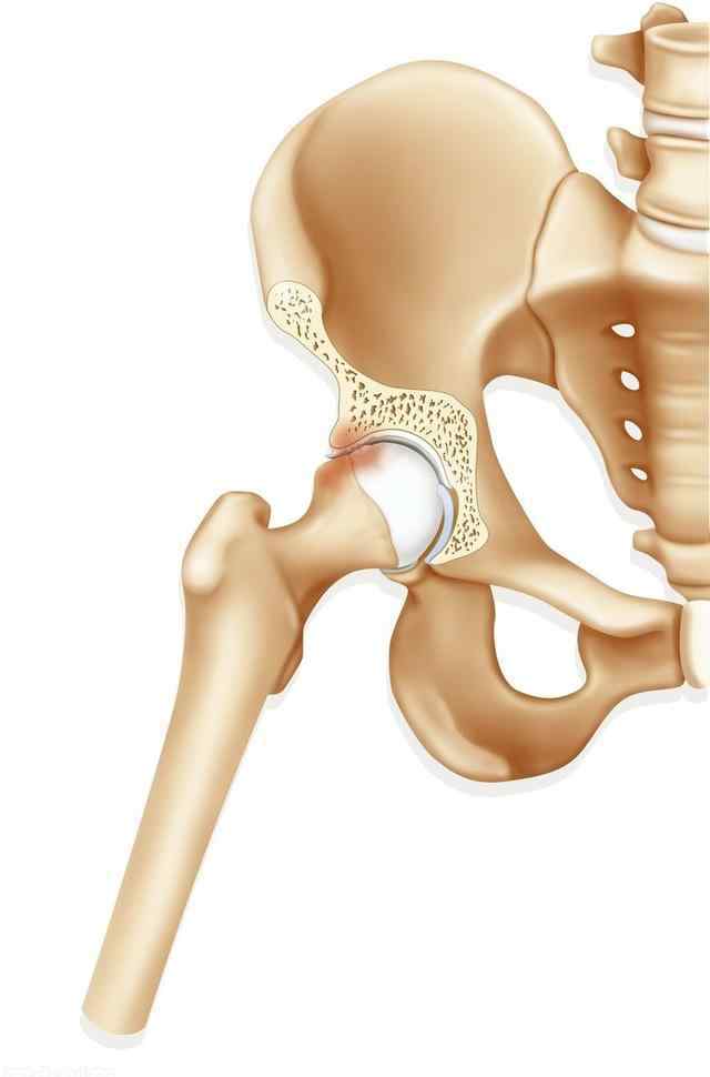 股骨頸骨折并發(fā)癥 股骨頸骨折的后期并發(fā)癥：股骨頭壞死，為何股骨頸骨折后容易壞死