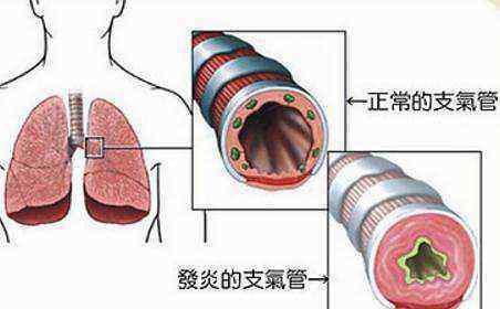 氣管炎癥狀 什么是氣管炎？氣管炎的癥狀是什么？