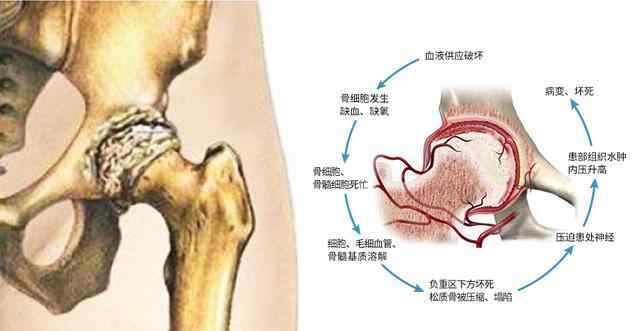 股骨頸骨折并發(fā)癥 股骨頸骨折的后期并發(fā)癥：股骨頭壞死，為何股骨頸骨折后容易壞死