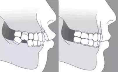 牙齒正常咬合 牙齒咬合正常的狀態(tài)是什么樣呢？