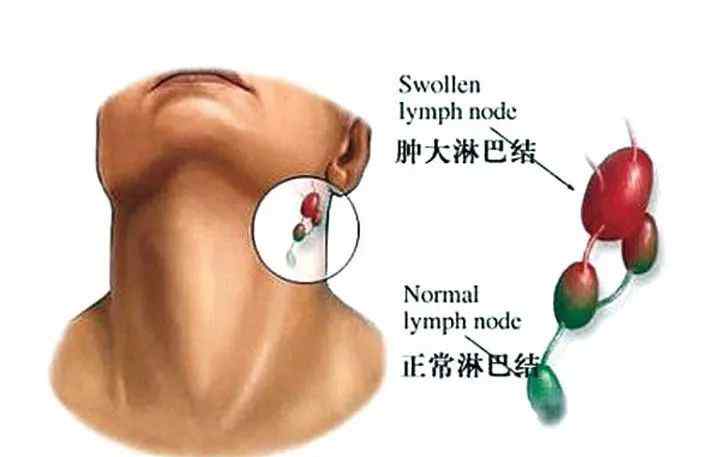 腫大淋巴結(jié)是什么意思 【醫(yī)生說(shuō)】體檢發(fā)現(xiàn)淋巴結(jié)腫大，到底是幾個(gè)意思？