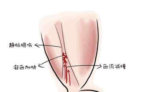 女孩崴腳后身亡 到底是怎么死的？