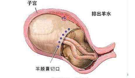 產(chǎn)后子宮恢復(fù)不好的癥狀 剖腹產(chǎn)后子宮恢復(fù)不好有哪些癥狀，這些癥狀你有嗎？