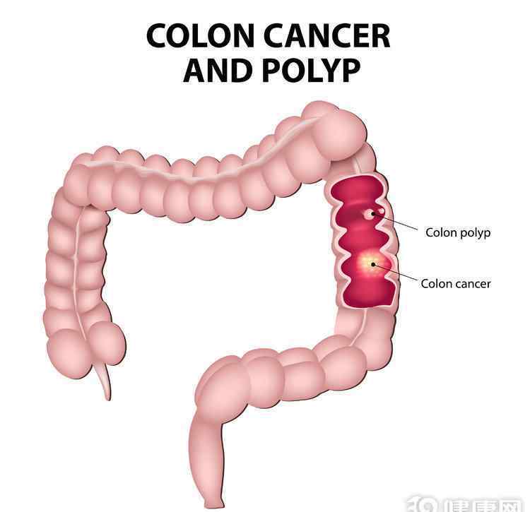 腸癌的早期癥狀和前兆 腸癌早期，癥狀很細微：排便有這些情況，留意了