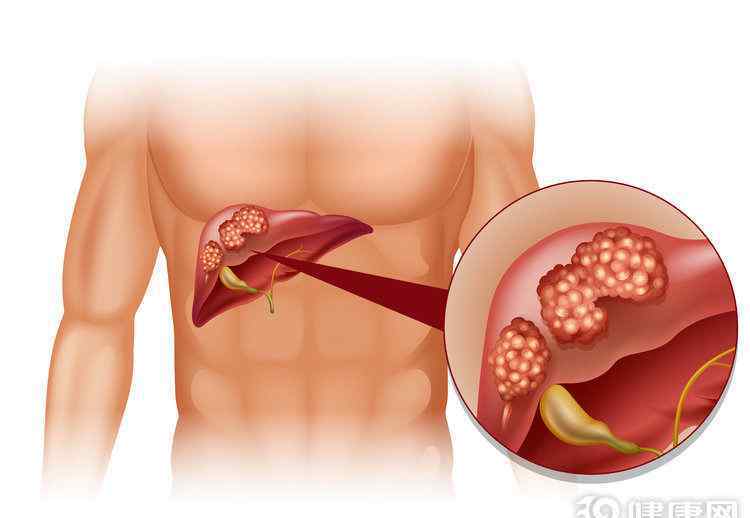 肝癌晚期介入治療 哪些肝癌病人要做介入治療？答案有4個，早做早受益