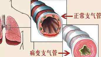 支氣管炎傳染人嗎 有支氣管炎的人進(jìn)行運(yùn)動(dòng)，給幾點(diǎn)忠告！