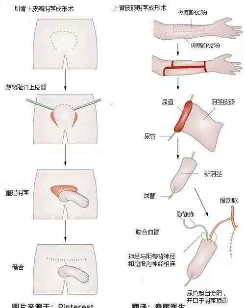 女變男手術(shù)后恢復(fù)圖 醫(yī)學(xué)解密：變性手術(shù)過程圖示（女變男）