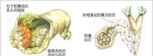 膽結石的偏方 不屑的膽結石：區(qū)區(qū)偏方就想消滅我，休想！