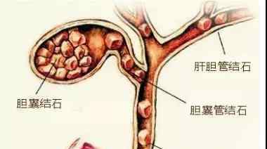 膽囊結(jié)石手術(shù)費 膽囊結(jié)石手術(shù)費是多少？看了這個你就知道！