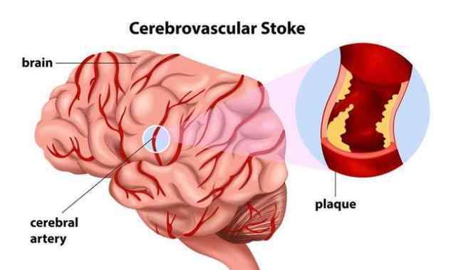 腦梗怎么判斷輕重 腦梗：1步自測、3步判斷、4步遠(yuǎn)離！建議50歲后收藏照做