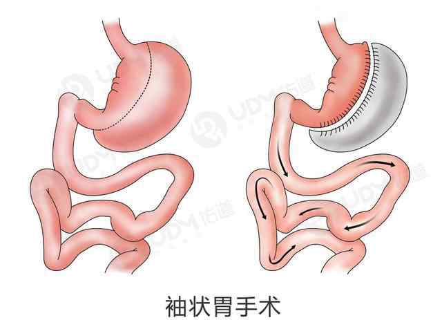 縮胃術(shù)減肥法 減肥有新法，縮胃手術(shù)你都了解嗎？