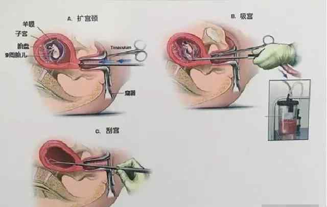 不出血不腹痛會胎停嗎 孕婦胎停了，但不肚子痛也不流血是怎么回事？別再無知了