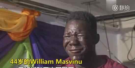 世界最丑的男人 世界最丑男人William Masvinu資料照片