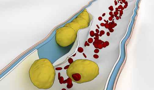 低密度脂蛋白膽固醇偏高怎么回事 低密度脂蛋白偏高怎么辦？醫(yī)生教你做好2點(diǎn)，有效減少心血管風(fēng)險(xiǎn)