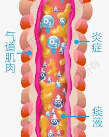 如何治療氣管炎哮喘 氣管炎、肺氣腫、慢阻肺、哮喘引起的咳嗽、氣喘怎么治療？