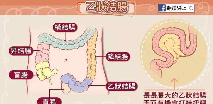 乙狀結(jié)腸 腸子也會(huì)打結(jié)？來看看乙狀結(jié)腸扭轉(zhuǎn)！