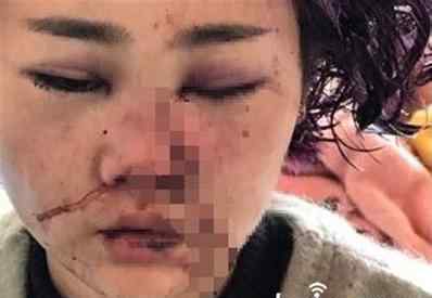 毀容女孩 麗江被打女孩小董毀容圖片，揭秘女孩麗江被打原因究竟是什么