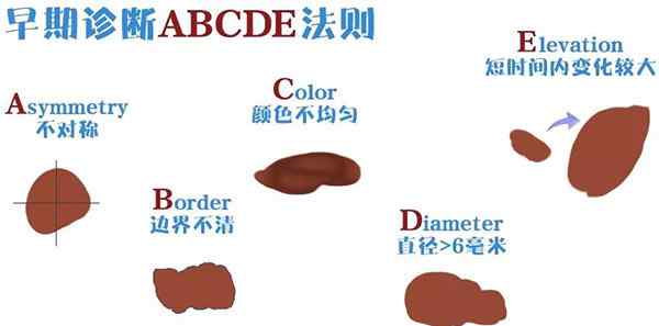 惡性黑色素瘤圖片 以為黑痣?yún)s是惡性黑色素瘤，這種疾病常常被人忽視耽誤治療