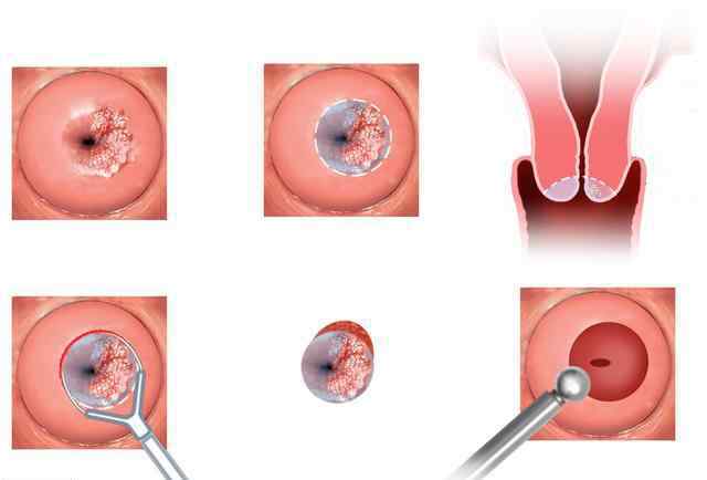 婦科醫(yī)生航天先進(jìn)ht 婦科醫(yī)生提醒：這3類女性，最容易被宮頸癌纏上，你可能也在其中