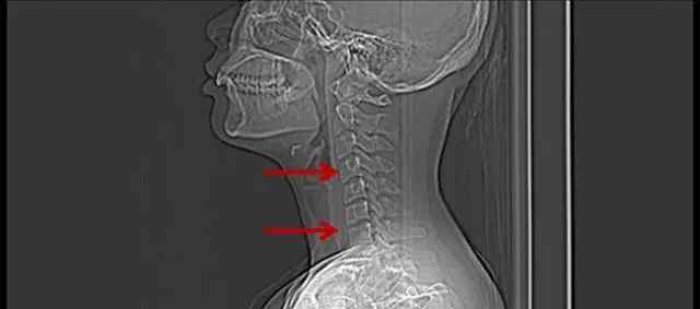 寰椎 頸椎CT天天看，這位27歲上班族的頸椎CT你看懂了嗎？