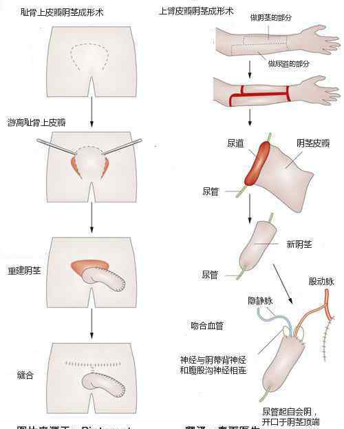 布施鮑姆 女變男真的可以當(dāng)男人嗎，世界上女變男的變性人真實照片