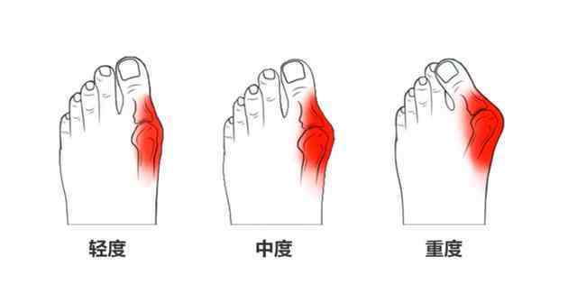 pansy Pansy盼潔鞋拯救您的拇趾外翻，再也不用做手術(shù)了