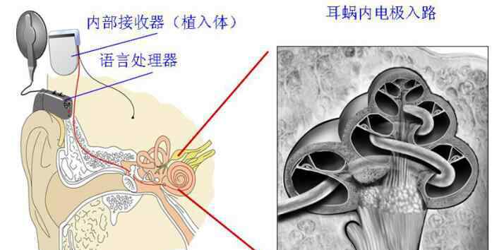 人造耳蝸 專家不建議做人工耳蝸真的嗎，人工耳蝸有什么后遺癥？