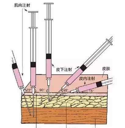 皮下針注射位置圖 皮內注射、皮下注射、肌肉注射、靜脈注射的區(qū)別！